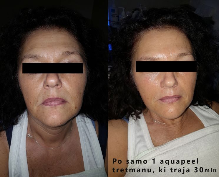 Innofacial Aquapeel PRIMER1